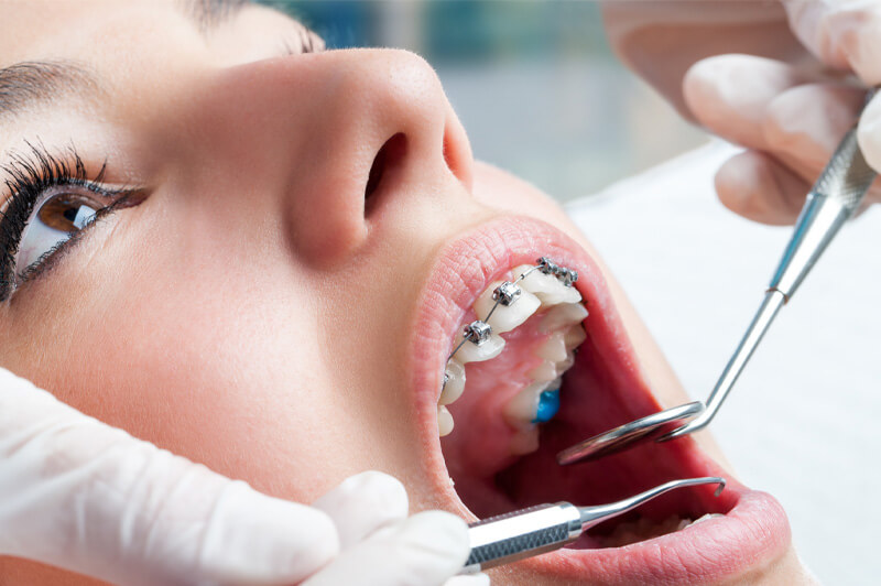 De rol van implantaten in orthodontische behandelingen