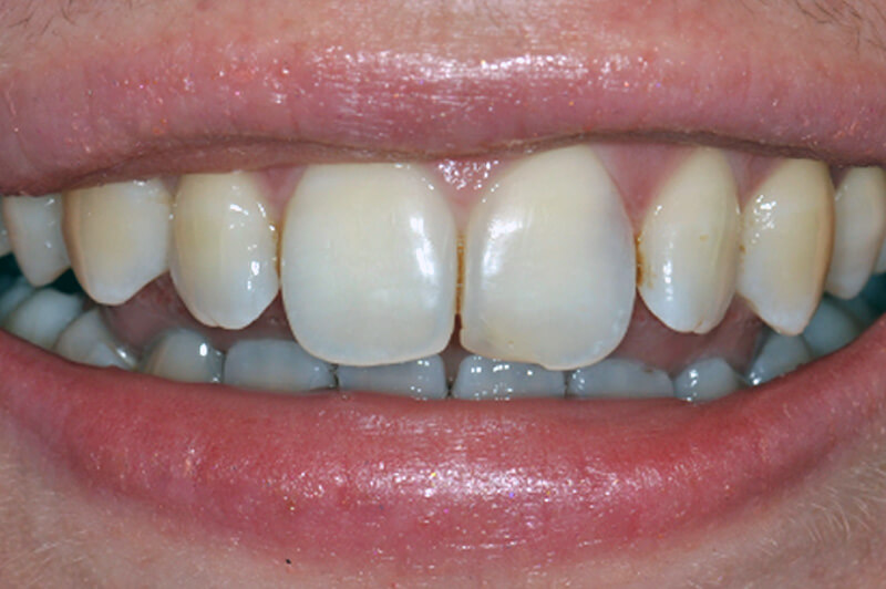 Cervicale wortelresorptie