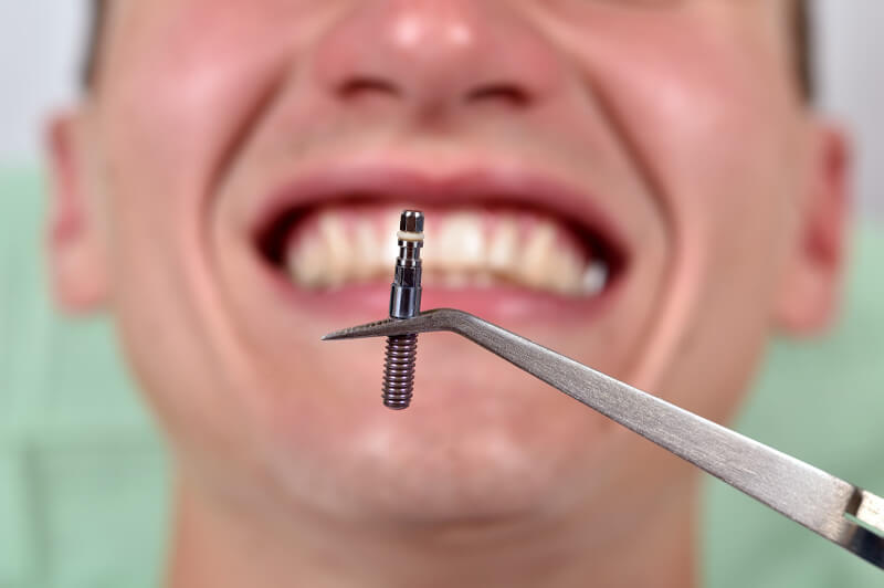Impact van implantaten op spraak