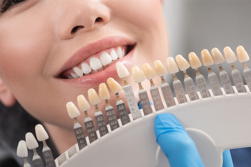 Implantaten en esthetiek
