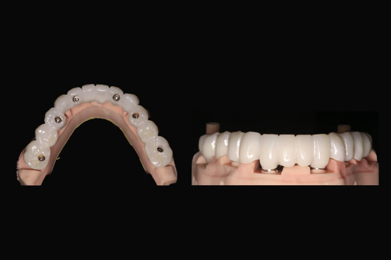 Een volledige brug vast op implantaten