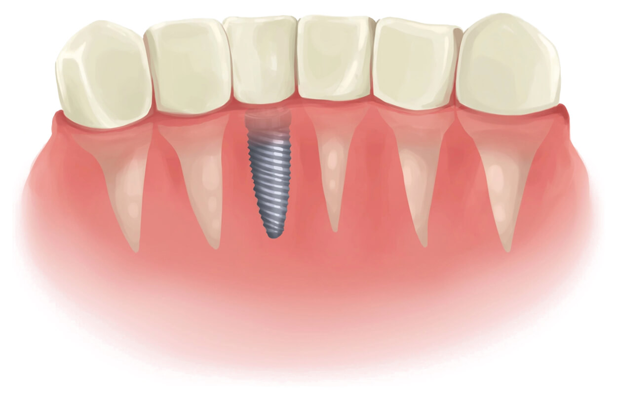 Implantaat en natuurlijke tanden