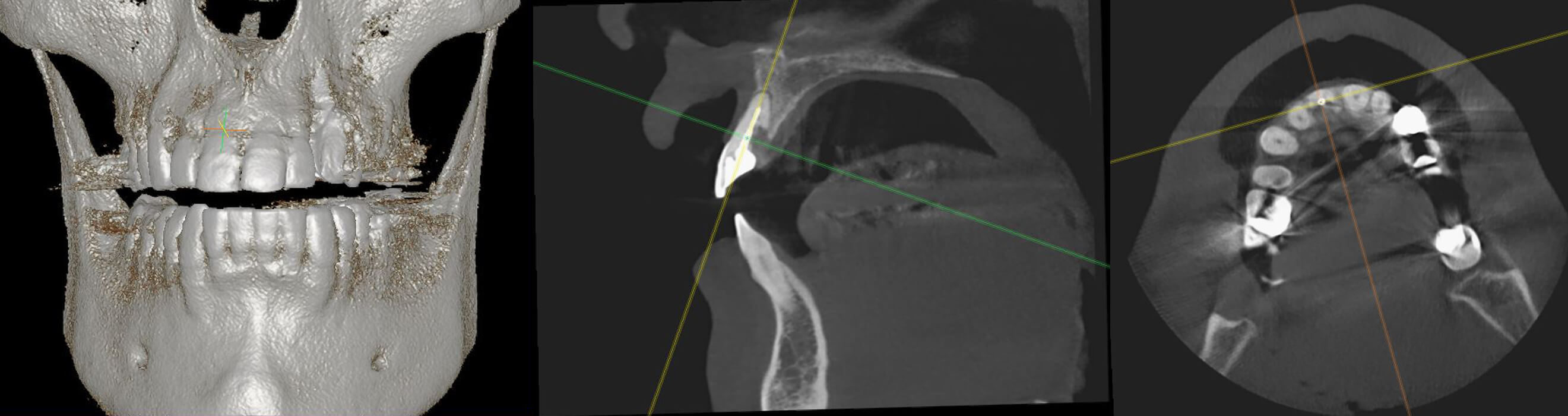 Voorbeeld van een Cone Beam CT-scan