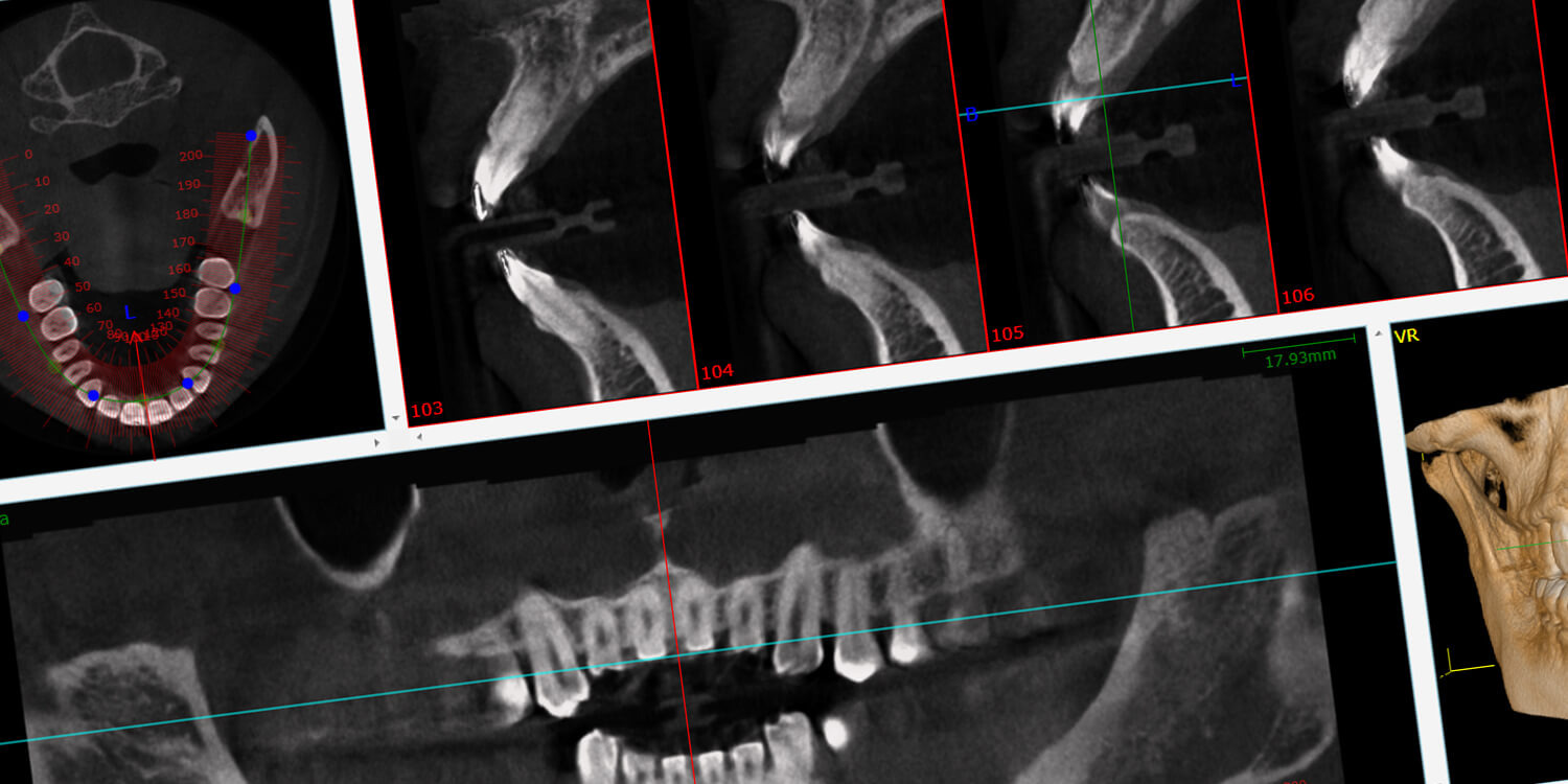 Digitale implantaat planning op een 3D-model van de kaak