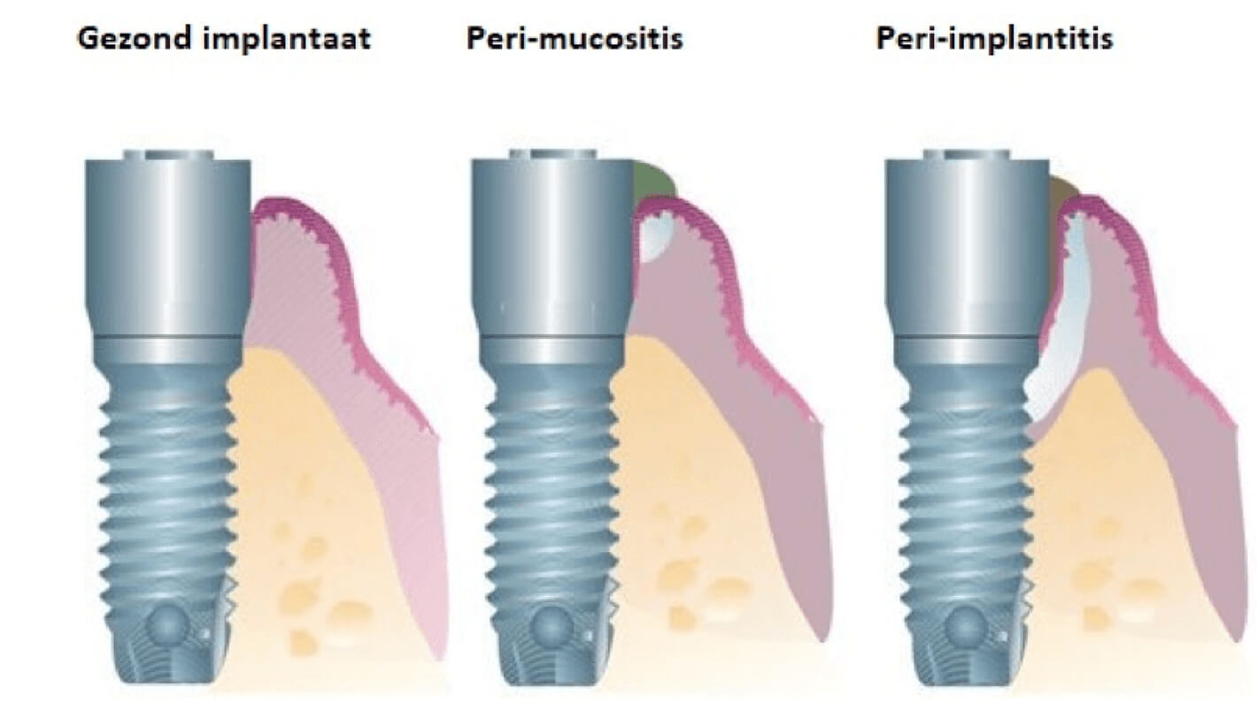 Peri-mucositis en peri-implantitis