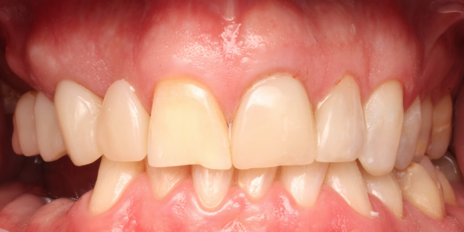 Wat kost een implantaat met een kroon? Blog Implantologiepraktijk