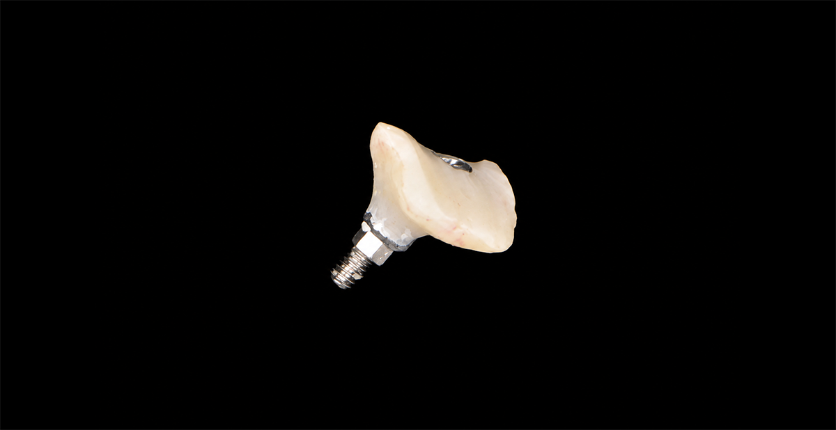 Voorbeeld van een geïndividualiseerd abutment