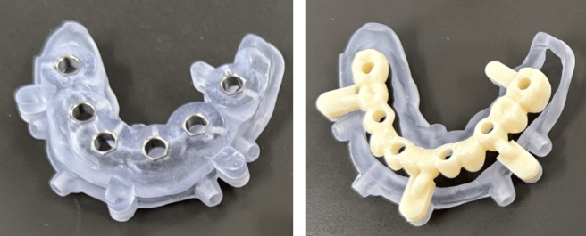 Dankzij guided surgery kan de FP1-behandeling nauwkeuriger en voorspelbaarder worden uitgevoerd.