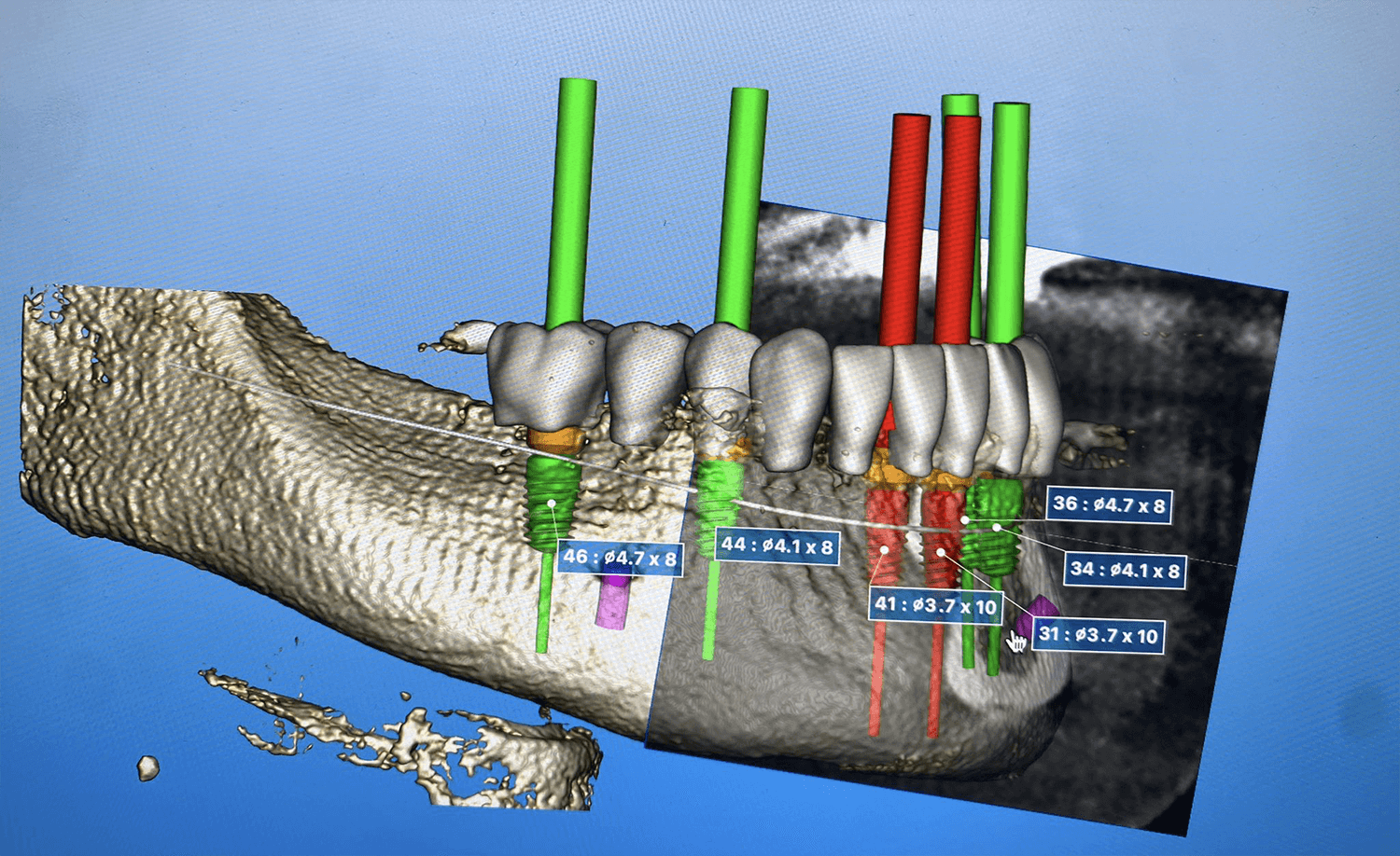 De digitale planning voor een guided surgery met immediate loading, waarbij de boormallen en de tijdelijke brug zijn ontworpen.