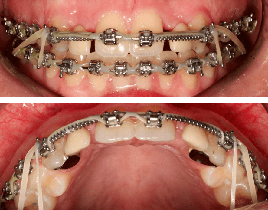 Situatie na orthodontische behandeling met voldoende ruimte voor de snijtanden