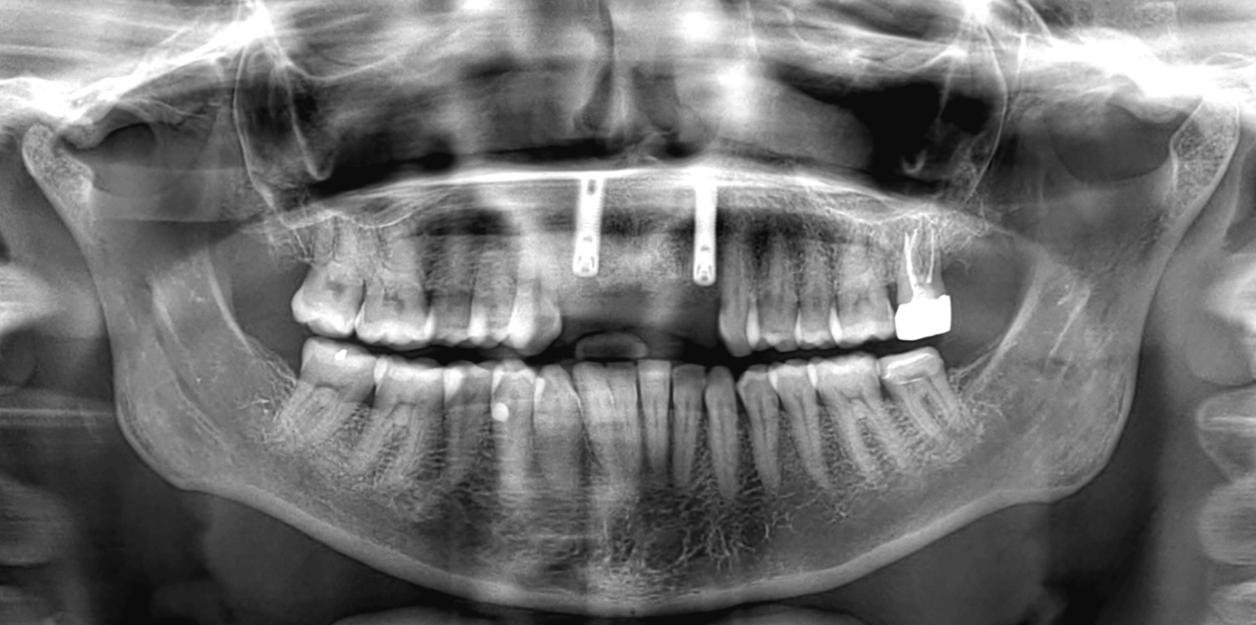 Röntgenfoto van de twee implantaten