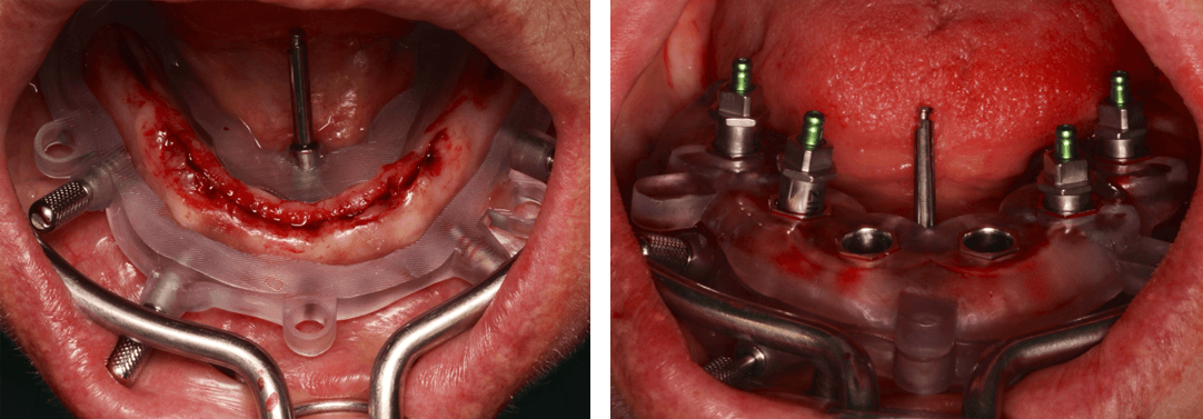 Het tandvlees is opzij geschoven en de implantaten zijn met de begeleidende boormal exact gepositioneerd.