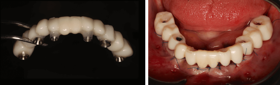De tijdelijke brug wordt buiten de mond waar nodig aangepast en direct op de implantaten in de mond vastgezet.