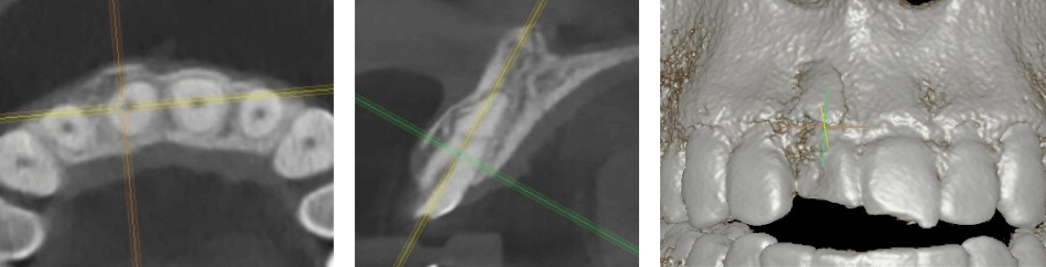 Met 3D-planning wordt de optimale positie van het implantaat bepaald.