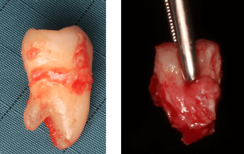 Een transplantaat uit het tubergebied bestaande uit botplaat, botkorrels en tandvlees wordt voorbereid.